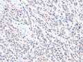 The image on the left is immunohistochemistry of paraffin-embedded Human esophagus cancer tissue using CSB-PA242662(ABLIM1 Antibody) at dilution 1/25, on the right is treated with fusion protein. (Original magnification: ×200)