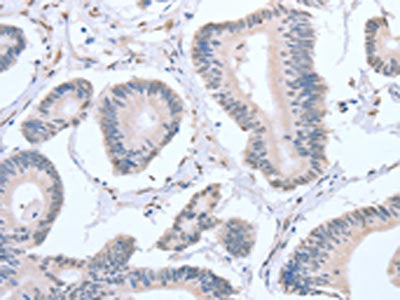 The image on the left is immunohistochemistry of paraffin-embedded Human colon cancer tissue using CSB-PA242845(APEX1 Antibody) at dilution 1/20, on the right is treated with fusion protein. (Original magnification: ×200)