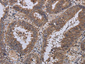 The image on the left is immunohistochemistry of paraffin-embedded Human colon cancer tissue using CSB-PA242915(LEPREL2 Antibody) at dilution 1/40, on the right is treated with fusion protein. (Original magnification: ×200)