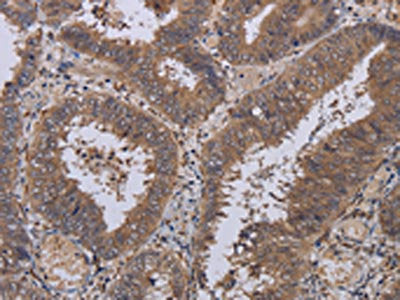 The image on the left is immunohistochemistry of paraffin-embedded Human colon cancer tissue using CSB-PA242915(LEPREL2 Antibody) at dilution 1/40, on the right is treated with fusion protein. (Original magnification: ×200)