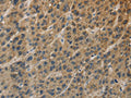 The image on the left is immunohistochemistry of paraffin-embedded Human liver cancer tissue using CSB-PA243064(TBXAS1 Antibody) at dilution 1/25, on the right is treated with fusion protein. (Original magnification: ×200)