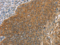 The image on the left is immunohistochemistry of paraffin-embedded Human cervical cancer tissue using CSB-PA243230(MAPK6 Antibody) at dilution 1/40, on the right is treated with synthetic peptide. (Original magnification: ×200)