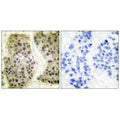 Immunohistochemical analysis of paraffin-embedded human breast carcinoma tissue using GANP antibody.