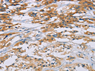 The image on the left is immunohistochemistry of paraffin-embedded Human thyroid cancer tissue using CSB-PA243594(CD33 Antibody) at dilution 1/40, on the right is treated with fusion protein. (Original magnification: ×200)