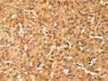The image on the left is immunohistochemistry of paraffin-embedded Human liver cancer tissue using CSB-PA243656(COLEC11 Antibody) at dilution 1/20, on the right is treated with fusion protein. (Original magnification: ×200)