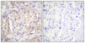 Immunohistochemical analysis of paraffin-embedded human breast carcinoma tissue using B-Raf (Phospho-Thr598) antibody (left)or the same antibody preincubated with blocking peptide (right).