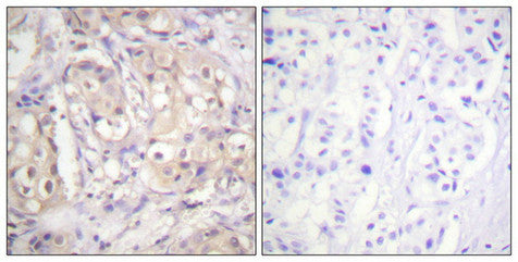Immunohistochemical analysis of paraffin-embedded human breast carcinoma tissue using B-Raf (Phospho-Thr598) antibody (left)or the same antibody preincubated with blocking peptide (right).