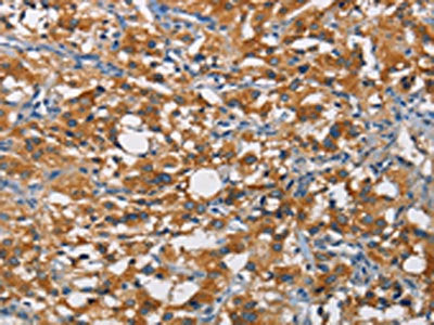 The image on the left is immunohistochemistry of paraffin-embedded Human thyroid cancer tissue using CSB-PA243691(CRTAM Antibody) at dilution 1/60, on the right is treated with fusion protein. (Original magnification: ×200)