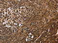 The image on the left is immunohistochemistry of paraffin-embedded Human cervical cancer tissue using CSB-PA244133(DCP1A Antibody) at dilution 1/50, on the right is treated with fusion protein. (Original magnification: ×200)