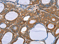 The image on the left is immunohistochemistry of paraffin-embedded Human thyroid cancer tissue using CSB-PA244470(NOS2 Antibody) at dilution 1/20, on the right is treated with synthetic peptide. (Original magnification: ×200)