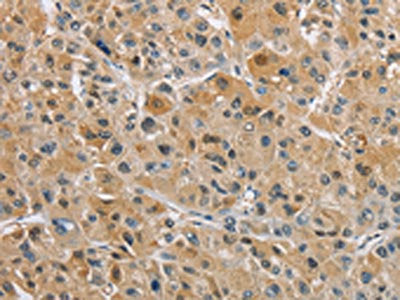 The image on the left is immunohistochemistry of paraffin-embedded Human liver cancer tissue using CSB-PA244536(NAPSA Antibody) at dilution 1/40, on the right is treated with fusion protein. (Original magnification: ×200)