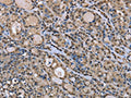 The image on the left is immunohistochemistry of paraffin-embedded Human thyroid cancer tissue using CSB-PA244606(DYNLL1 Antibody) at dilution 1/30, on the right is treated with fusion protein. (Original magnification: ×200)