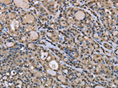 The image on the left is immunohistochemistry of paraffin-embedded Human thyroid cancer tissue using CSB-PA244606(DYNLL1 Antibody) at dilution 1/30, on the right is treated with fusion protein. (Original magnification: ×200)
