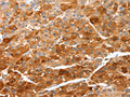 The image on the left is immunohistochemistry of paraffin-embedded Human liver cancer tissue using CSB-PA244699(CIDEC Antibody) at dilution 1/50, on the right is treated with fusion protein. (Original magnification: ×200)