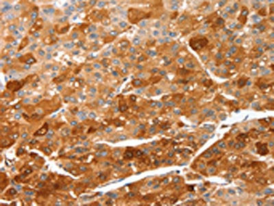 The image on the left is immunohistochemistry of paraffin-embedded Human liver cancer tissue using CSB-PA244699(CIDEC Antibody) at dilution 1/50, on the right is treated with fusion protein. (Original magnification: ×200)
