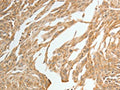 The image is immunohistochemistry of paraffin-embedded Human cervical cancer tissue using CSB-PA245152(TWIST1 Antibody) at dilution 1/15. (Original magnification: ×200)
