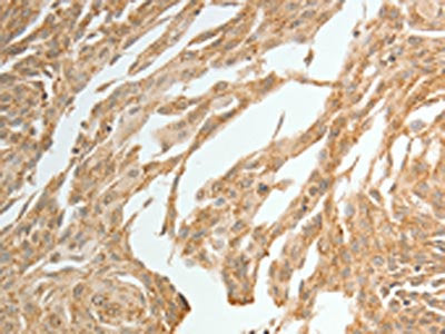 The image is immunohistochemistry of paraffin-embedded Human cervical cancer tissue using CSB-PA245152(TWIST1 Antibody) at dilution 1/15. (Original magnification: ×200)