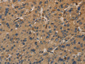 The image on the left is immunohistochemistry of paraffin-embedded Human liver cancer tissue using CSB-PA245297(UBE2S Antibody) at dilution 1/40, on the right is treated with fusion protein. (Original magnification: ×200)