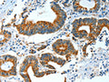 The image on the left is immunohistochemistry of paraffin-embedded Human colon cancer tissue using CSB-PA245428(BAG3 Antibody) at dilution 1/25, on the right is treated with fusion protein. (Original magnification: ×200)