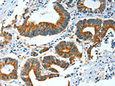 The image on the left is immunohistochemistry of paraffin-embedded Human colon cancer tissue using CSB-PA245428(BAG3 Antibody) at dilution 1/25, on the right is treated with fusion protein. (Original magnification: ×200)