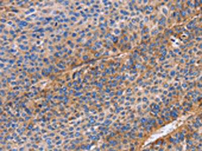 The image on the left is immunohistochemistry of paraffin-embedded Human liver cancer tissue using CSB-PA245433(ITGB1 Antibody) at dilution 1/60, on the right is treated with fusion protein. (Original magnification: ×200)