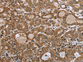 The image on the left is immunohistochemistry of paraffin-embedded Human thyroid cancer tissue using CSB-PA246122(NDUFS2 Antibody) at dilution 1/35, on the right is treated with synthetic peptide. (Original magnification: ×200)
