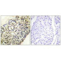 Immunohistochemistry analysis of paraffin-embedded human breast carcinoma tissue, using LATH antibody.
