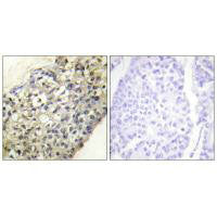 Immunohistochemistry analysis of paraffin-embedded human breast carcinoma tissue, using LATH antibody.