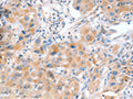 The image on the left is immunohistochemistry of paraffin-embedded Human lung cancer tissue using CSB-PA246246(ACOX2 Antibody) at dilution 1/20, on the right is treated with fusion protein. (Original magnification: ×200)