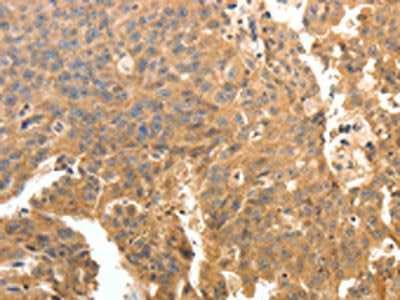 The image on the left is immunohistochemistry of paraffin-embedded Human ovarian cancer tissue using CSB-PA246334(PTPRE Antibody) at dilution 1/10, on the right is treated with fusion protein. (Original magnification: ×200)