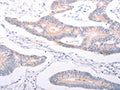 The image on the left is immunohistochemistry of paraffin-embedded Human colon cancer tissue using CSB-PA246386(ANKRA2 Antibody) at dilution 1/25, on the right is treated with synthetic peptide. (Original magnification: ×200)