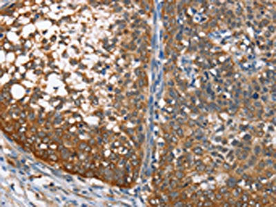 The image on the left is immunohistochemistry of paraffin-embedded Human cervical cancer tissue using CSB-PA246770(MAD2L1BP Antibody) at dilution 1/65, on the right is treated with fusion protein. (Original magnification: ×200)