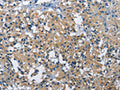 The image on the left is immunohistochemistry of paraffin-embedded Human thyroid cancer tissue using CSB-PA247127(BMPR1B Antibody) at dilution 1/30, on the right is treated with fusion protein. (Original magnification: ×200)