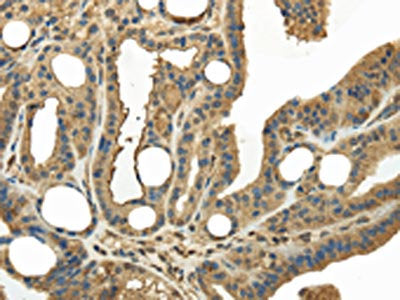 The image on the left is immunohistochemistry of paraffin-embedded Human thyroid cancer tissue using CSB-PA247380(KEAP1 Antibody) at dilution 1/20, on the right is treated with fusion protein. (Original magnification: ×200)