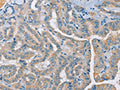The image on the left is immunohistochemistry of paraffin-embedded Human thyroid cancer tissue using CSB-PA247431(RAD51 Antibody) at dilution 1/25, on the right is treated with synthetic peptide. (Original magnification: ×200)