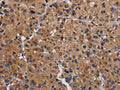 The image on the left is immunohistochemistry of paraffin-embedded Human liver cancer tissue using CSB-PA247539(GNAS Antibody) at dilution 1/30, on the right is treated with fusion protein. (Original magnification: ×200)