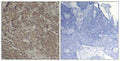 Immunohistochemical analysis of paraffin-embedded human breast carcinoma tissue using CREB(Ab-142) Antibody(left) or the same antibody preincubated with blocking peptide(right).