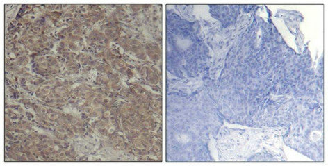 Immunohistochemical analysis of paraffin-embedded human breast carcinoma tissue using CREB(Ab-142) Antibody(left) or the same antibody preincubated with blocking peptide(right).