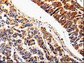 The image on the left is immunohistochemistry of paraffin-embedded Human lung cancer tissue using CSB-PA247988(IL1R2 Antibody) at dilution 1/20, on the right is treated with fusion protein. (Original magnification: ×200)
