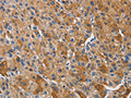 The image on the left is immunohistochemistry of paraffin-embedded Human liver cancer tissue using CSB-PA248038(KLK1 Antibody) at dilution 1/40, on the right is treated with fusion protein. (Original magnification: ×200)