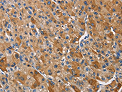 The image on the left is immunohistochemistry of paraffin-embedded Human liver cancer tissue using CSB-PA248038(KLK1 Antibody) at dilution 1/40, on the right is treated with fusion protein. (Original magnification: ×200)