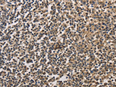 The image on the left is immunohistochemistry of paraffin-embedded Human tonsil tissue using CSB-PA248125(DRG1 Antibody) at dilution 1/20, on the right is treated with fusion protein. (Original magnification: ×200)