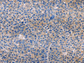 The image on the left is immunohistochemistry of paraffin-embedded Human liver cancer tissue using CSB-PA248410(AMACR Antibody) at dilution 1/30, on the right is treated with fusion protein. (Original magnification: ×200)