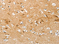 The image on the left is immunohistochemistry of paraffin-embedded Human brain tissue using CSB-PA248529(AP2M1 Antibody) at dilution 1/20, on the right is treated with fusion protein. (Original magnification: ×200)