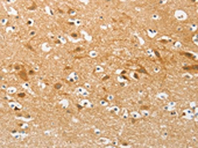 The image on the left is immunohistochemistry of paraffin-embedded Human brain tissue using CSB-PA248529(AP2M1 Antibody) at dilution 1/20, on the right is treated with fusion protein. (Original magnification: ×200)
