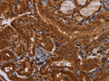 The image on the left is immunohistochemistry of paraffin-embedded Human thyroid cancer tissue using CSB-PA248639(WDR83 Antibody) at dilution 1/30, on the right is treated with fusion protein. (Original magnification: ×200)