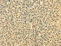 The image on the left is immunohistochemistry of paraffin-embedded Human ovarian cancer tissue using CSB-PA249582(RPA2 Antibody) at dilution 1/40, on the right is treated with fusion protein. (Original magnification: ×200)
