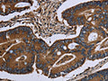 The image on the left is immunohistochemistry of paraffin-embedded Human colon cancer tissue using CSB-PA249653(ITGA2B Antibody) at dilution 1/40, on the right is treated with fusion protein. (Original magnification: ×200)