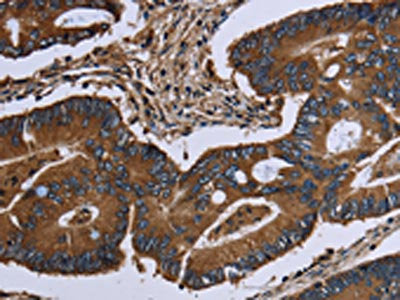 The image on the left is immunohistochemistry of paraffin-embedded Human colon cancer tissue using CSB-PA249653(ITGA2B Antibody) at dilution 1/40, on the right is treated with fusion protein. (Original magnification: ×200)