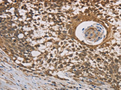 The image on the left is immunohistochemistry of paraffin-embedded Human cervical cancer tissue using CSB-PA249679(HSF1 Antibody) at dilution 1/20, on the right is treated with fusion protein. (Original magnification: ×200)